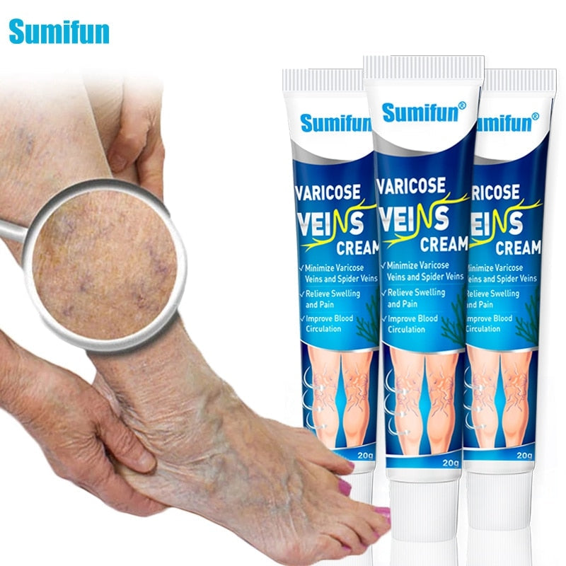 Varicose veins, Diga adeus para suas Varizes e Inchaços.