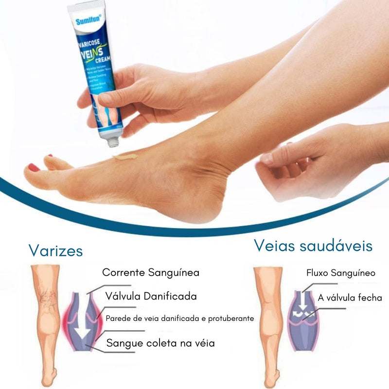 Varicose veins, Diga adeus para suas Varizes e Inchaços.